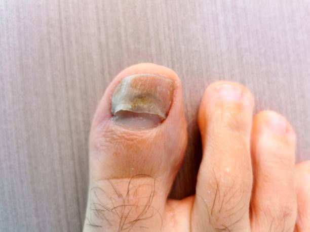 reconstrucción podologica de las uñas del pie para uñas dañadas