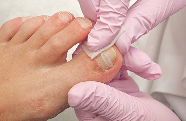 reconstrucción en clínica podológica de la uña del pie